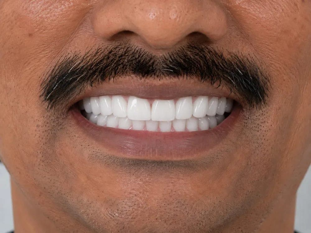 Full Smile Makeover — after treatment