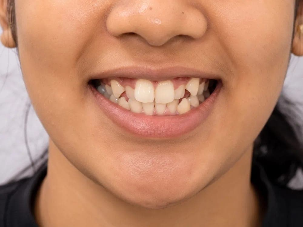 Braces Alignment — before treatment
