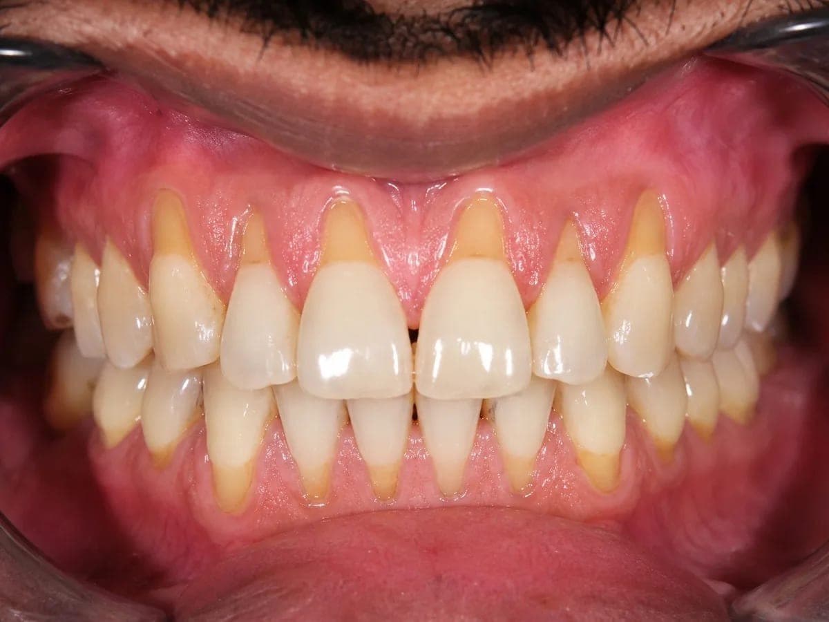 Gum Recession