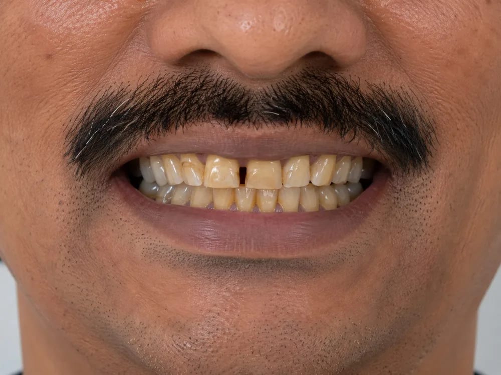 Full Smile Makeover — before treatment