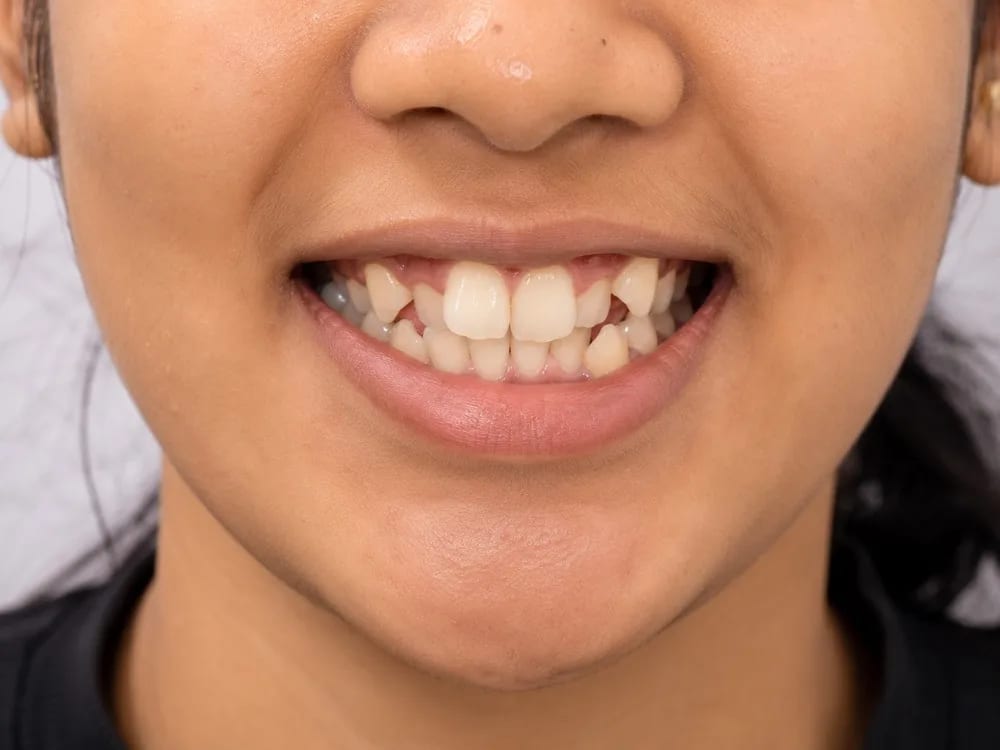 Braces Alignment — before treatment